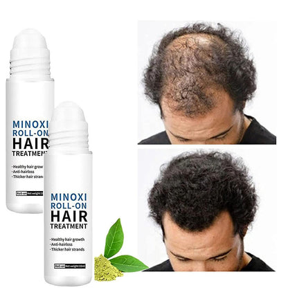 Minoxi Roll-on Hair Treatment,minoxidil Minoxidil Hair Regrowth Treatment, Minoxidil