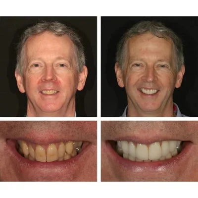 LuminSmile™ Teeth Whitening Essence