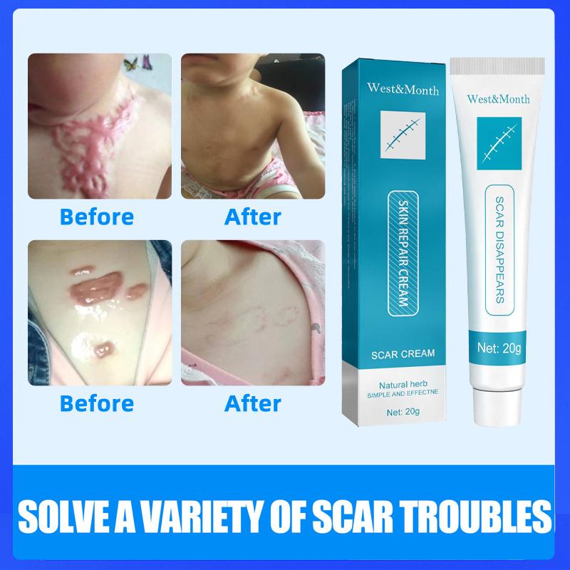Scar Removal Cream Repair Gel For Acne Spots Dent Face Body Burn Scar Smooth Repair Cream Skin Care