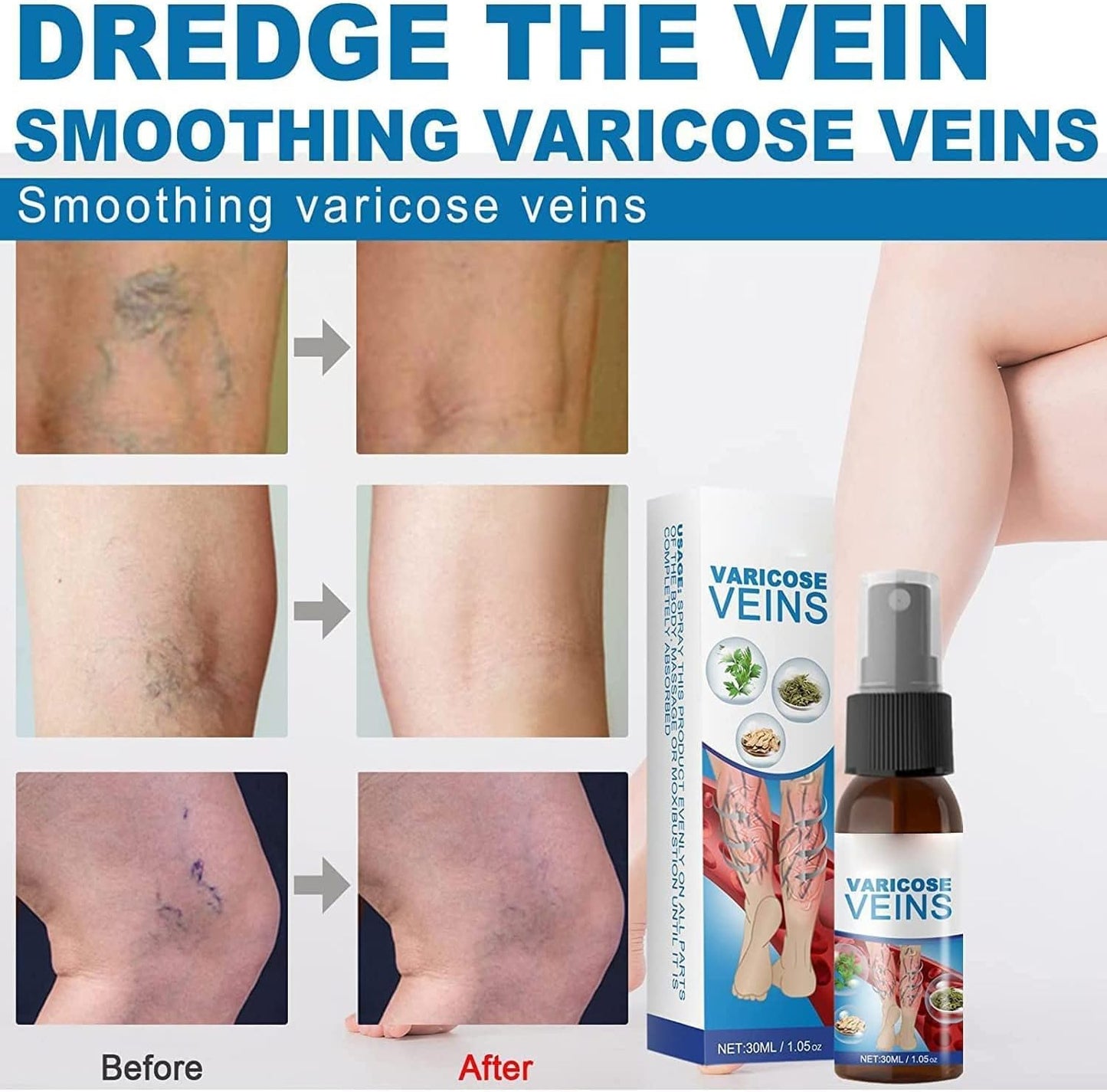 Varicose Veins Treatment Spray, Varicose Veins Spray, Varicose Vein Soothing Spray Vein Treatment Spray, Varicose Veins Spray for Legs