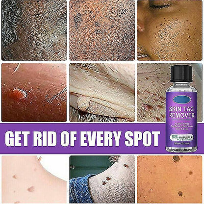 30ml Mole Wart Mole Face Neck Skin Tag Removal Solution Natural Dark Spot Remover