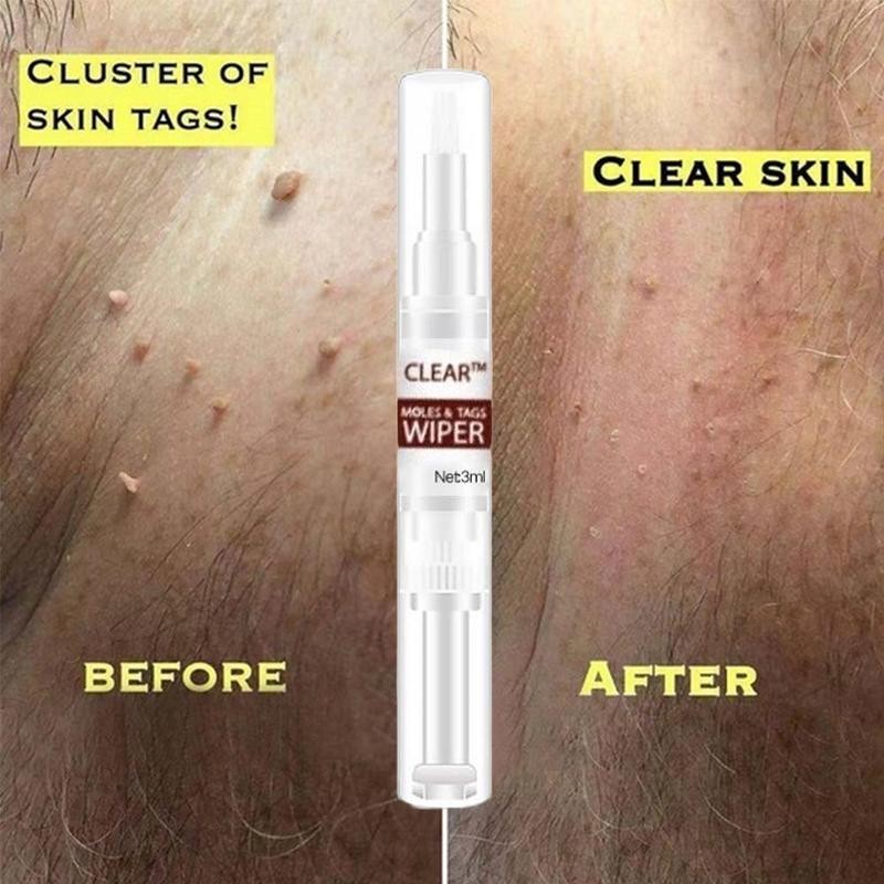 Liquid Pen Mole Removal Papilloma Treatment Warts Liquid Skin Tag Remover Anti Wart Remedy