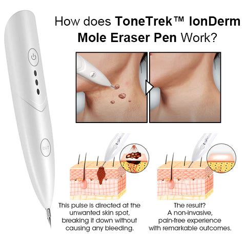 ToneTrek™ IonDerm Mole Eraser
